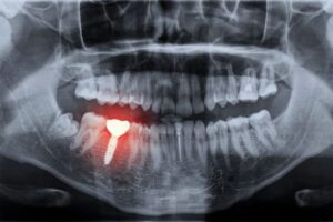 dental implants a appropriate